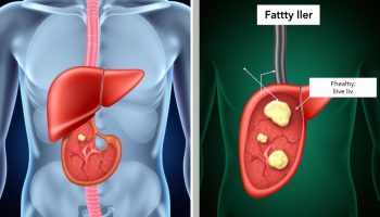 7 Remédios Caseiros Para Gordura No Fígado: Tratamentos