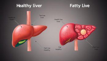 Tratamento para Gordura no Fígado: Soluções Eficazes e Naturais
